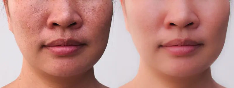 White Spots On Skin Reasons, Types, And Fixes